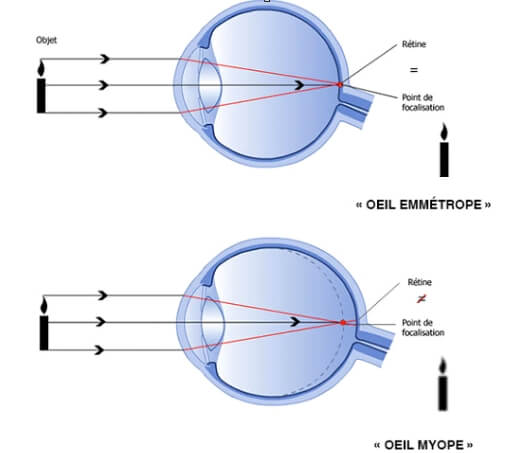 illustration_myopie-forte