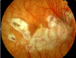 photo_myopie-forte_01